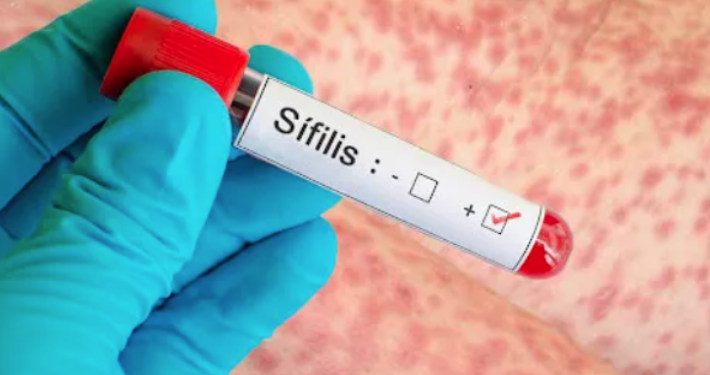 Preocupación por el aumento de casos de sífilis en Argentina